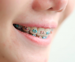 blue and red braces