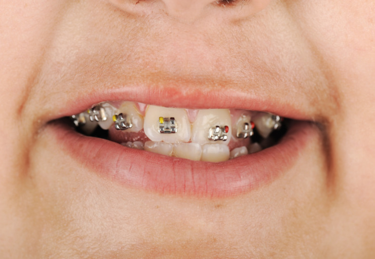 At What Age Do Kids Get Braces When Can You Get Braces?