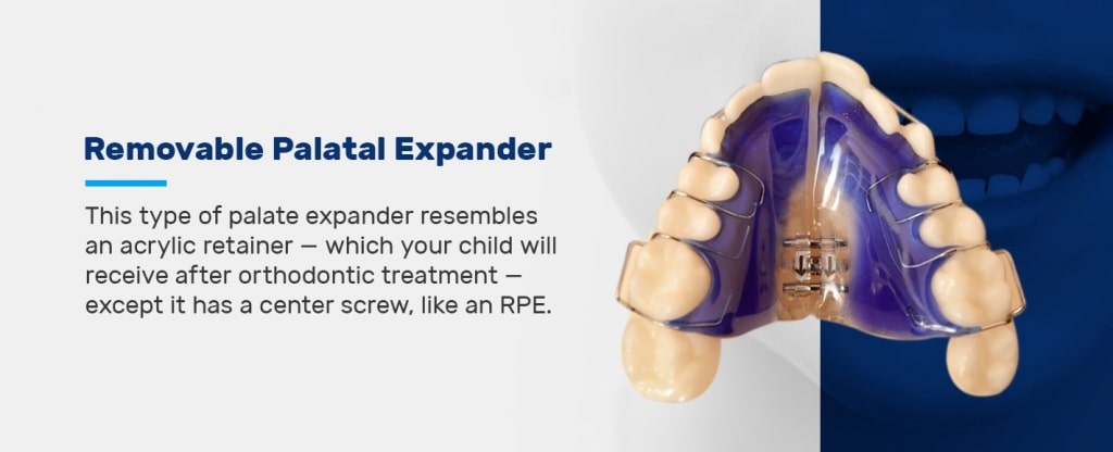 Rapid Palatal Expander - Align Orthodontics : Align Orthodontics